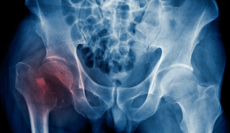 study-hip-fracture-burden-to-nearly-double-worldwide-by-2050-harvard