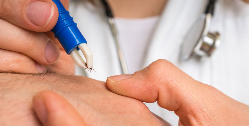 Physician extracting a tick with tweezers 