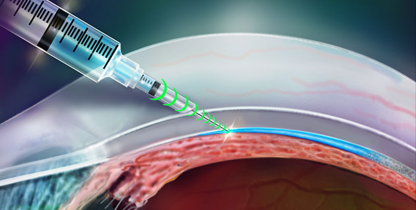 Researchers invent a resistance-sensing injection device that knows where to go