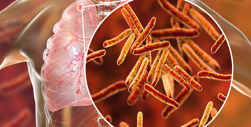 secondary tb in lunch and close-up of tb bacteria