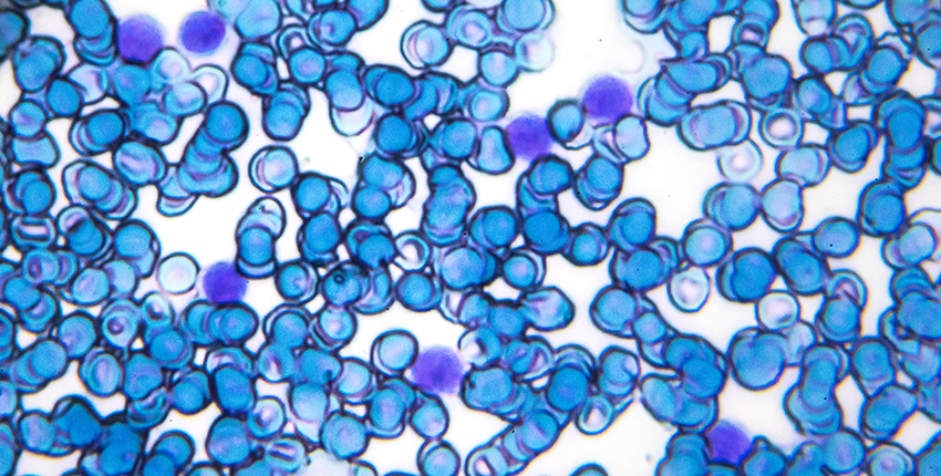 leukemia cells