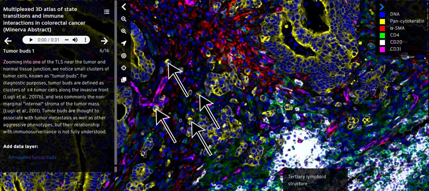 A narration panel on the left side, with multicolored colorectal cancer cells on the right side. 