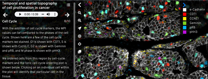 A narration panel on the left side, with multicolored breast cancer cells on the right side. 