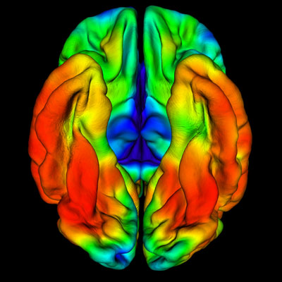 Pet Scan image of the brain showing tau areas