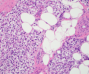 Aparecen células claras con forma de burbuja entre células más pequeñas teñidas de rosa en un portaobjetos histológico