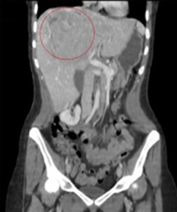 CT scan of a midsection with a large red circle indicating a liver mass